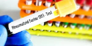 Rheumatoid Factor (RF) Test