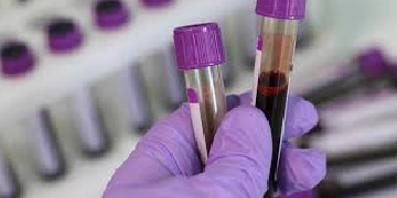 Beta Human Chorionic Gonadotropin (β-hCG)