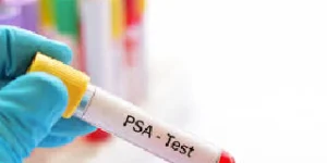 Prostate Specific Antigen (PSA) Test